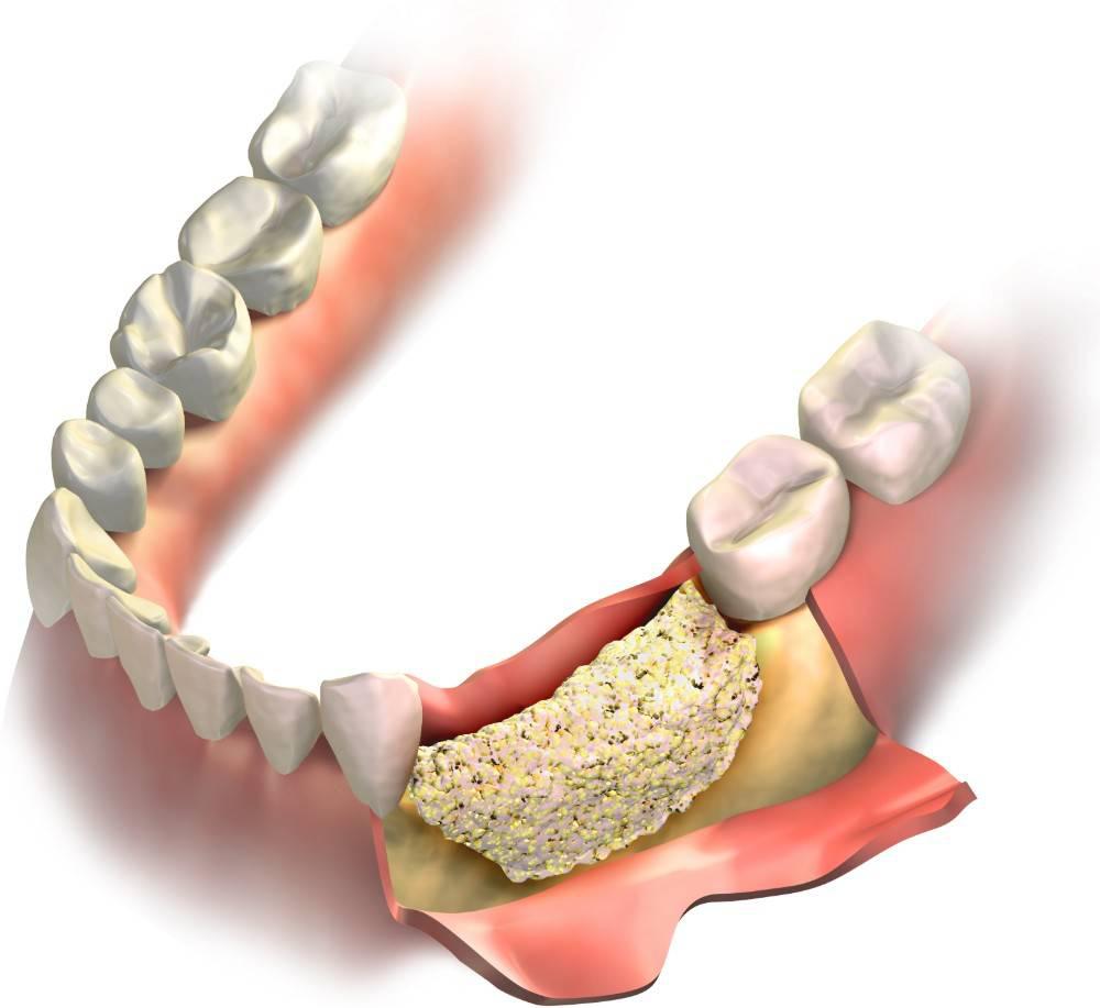 Bone Grafting Chicago, IL