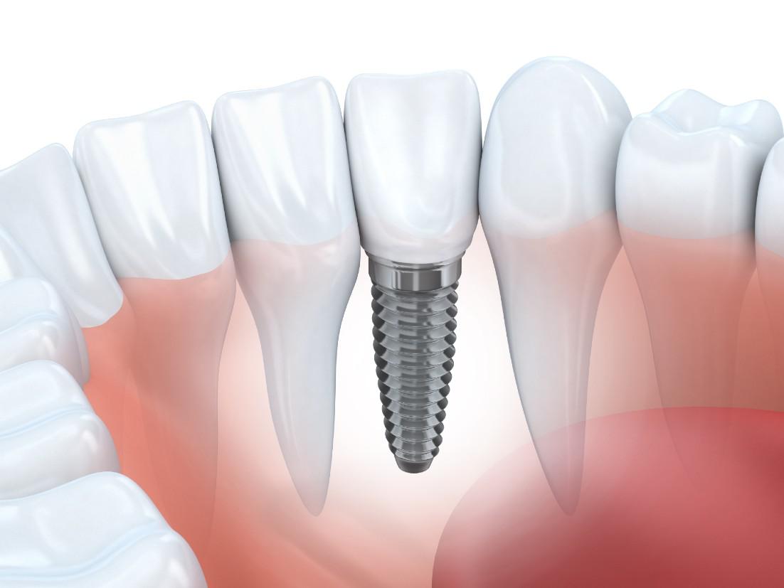 Dental Implants Chicago, IL